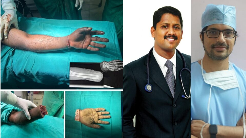 The doctor successfully reattached the hand of a laborer who got stuck in a tree cutting machine! ಮರ ಕತ್ತರಿಸುವ ಯಂತ್ರಕ್ಕೆ ಸಿಲುಕಿ ತುಂಡಾಗಿದ್ದ ಕಾರ್ಮಿಕನ ಕೈಯನ್ನು, ಯಶಸ್ವಿಯಾಗಿ ಮರುಜೋಡಿಸಿದ ವೈದ್ಯರು!